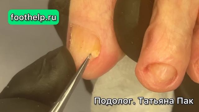 Улучшить качество жизни. Пациент 80+ смотреть онлайн