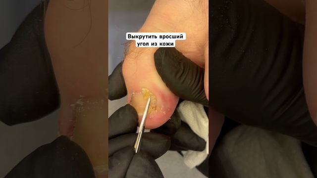 Угол ногтя врос в кожу бокового валика #вросшийноготь #ingrown_toenail_surgery смотреть онлайн