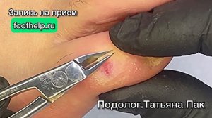Удаление болезненной сухой мозоли на мизинце