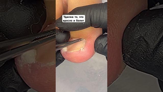 Вытащить осколок вросшего ногтя #ingrown_toenail_surgery #вросшийноготь смотреть онлайн