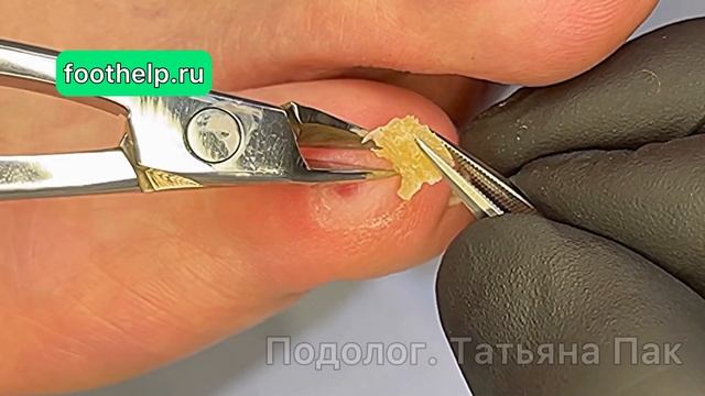 Мизинец- локация образования стержневой мозоли у любителей тесной обуви #удалениемозоли смотреть онлайн