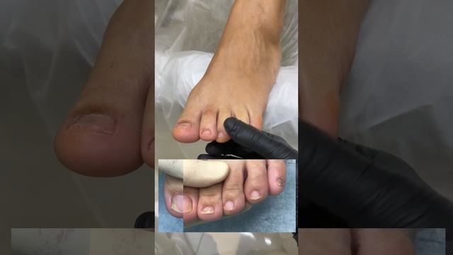 Победа над грибком на ногтях. Больше видео на моем канале @podologmoscow #грибокногтей смотреть онлайн