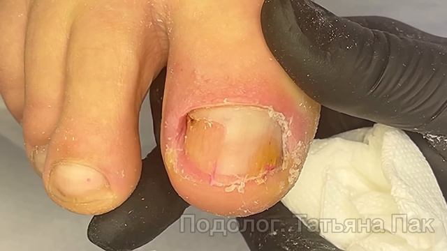 Ноготь дал трещину | прирастет если помазать красным смотреть онлайн