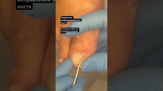Раскрутить ногти в правильную форму #вросшийноготь #ingrown_toenail_surgery #подологтатьянапак смотреть онлайн