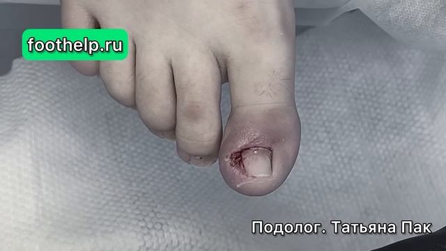 Достать острый осколок ногтя в отекшем гнойном боковом валике смотреть онлайн