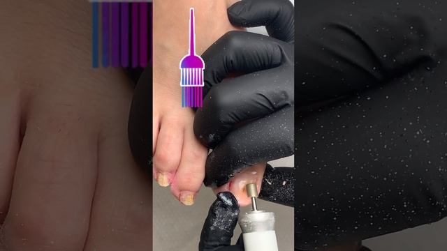 Закрасить грибок лаком #грибокногтей #онихомикоз #грибокногтейлечение #подологмосква смотреть онлайн