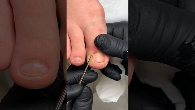 «Сразу стало легче!» #вросшиеногти смотреть онлайн