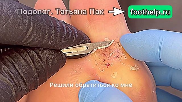 Бородавка в активной фазе. Способы удаления бородавки. Бородавка дает деток #подологтатьянапак смотреть онлайн