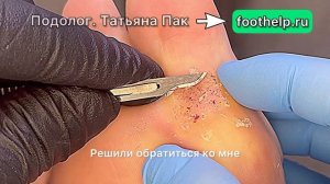 Бородавка в активной фазе. Способы удаления бородавки. Бородавка дает деток #подологтатьянапак
