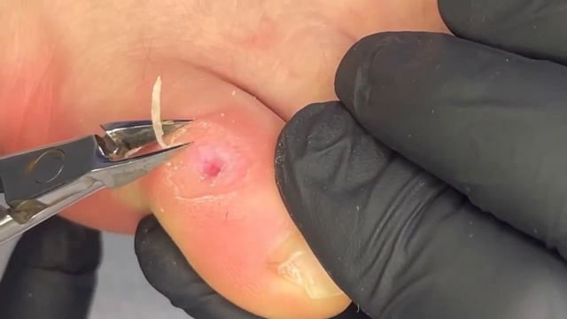 Было больнее чем у стоматолога | #мозоли #удалениемозоли смотреть онлайн