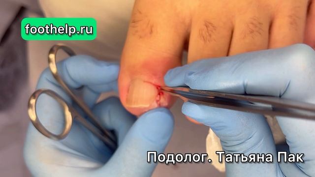 Удалить то что вросло. Регенерация бокового валика #подологтатьянапак смотреть онлайн