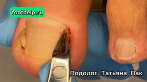 Визит к подологу неизбежно | два вросших угла