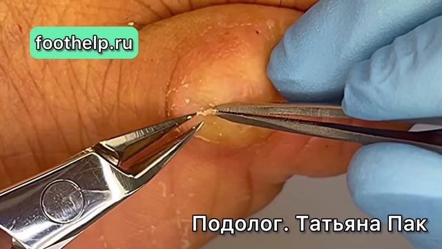 Удаляю МОЗОЛЬ полностью, но растет снова смотреть онлайн