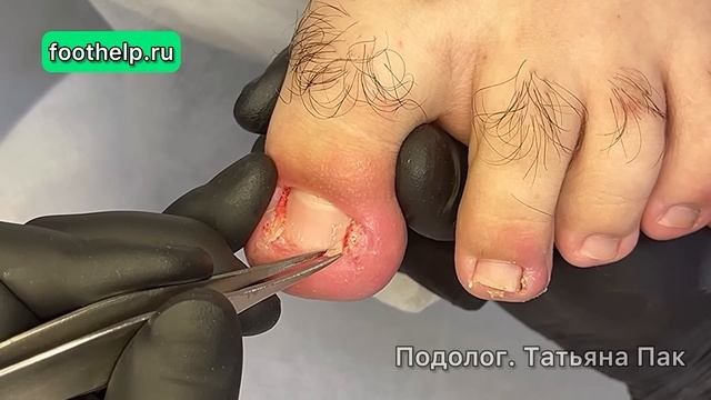 Найти и удалить вросшие фрагменты ногтей в отекшем загнивающем пальце. Ощущения пациента смотреть онлайн