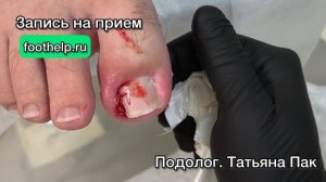 Удаление вросшего ногтя