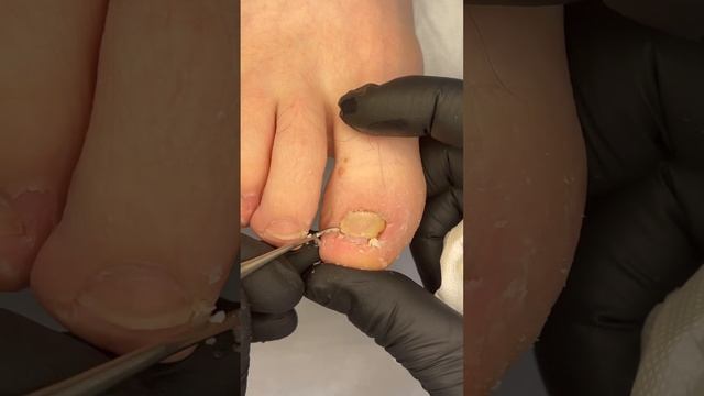 Под ногтем растет новый ноготь #мозоли #давление #подологмосква смотреть онлайн