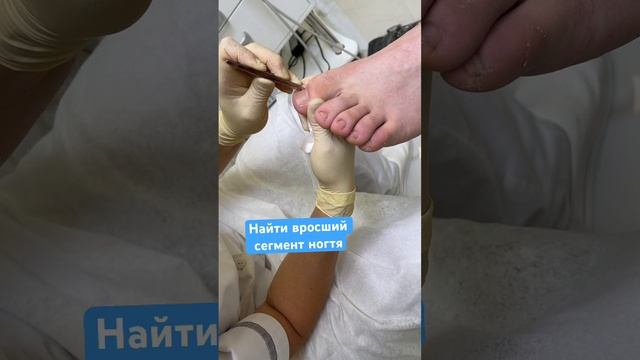 Решить проблему вросшего ногтя #ingrown_toenail_surgery #вросшийноготь смотреть онлайн