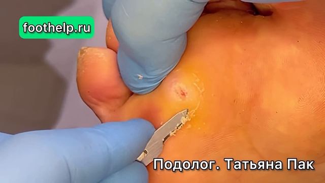 Плотное, жесткое, округлой формы на стопе смотреть онлайн