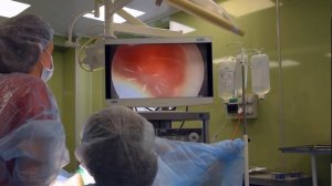 Гистероскопия: удаление ВМС