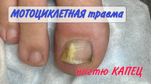 Подногтевой панариций_ жёлтый ноготь_ воспаление под ногтем