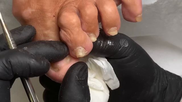 Состояние ногтей при острой форме заболевания суставов | первая помощь #подологтатьянапак смотреть онлайн