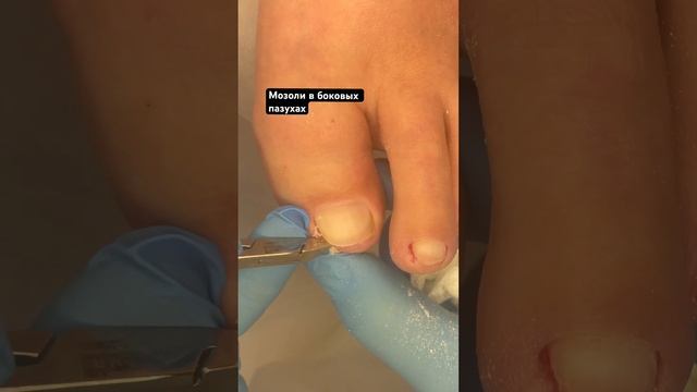 Удаление подногтевых кожных залежей #мозоли смотреть онлайн