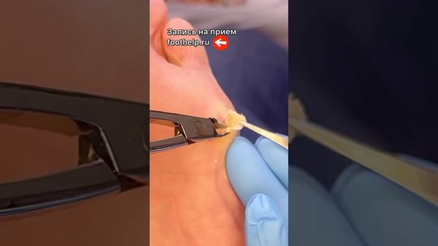 Мозоль - кнопка. Удалить у #подологтатьянапак быстро и не больно #мозолька смотреть онлайн