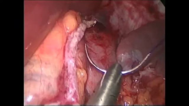 Needloscopic Bariatric Surgery - Low cost Painless & Scar free weight loss surgery In Delhi India смотреть онлайн