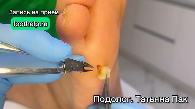 Жесткий и толстый корень у мозоли глубоко в мягких тканях плюсны стопы смотреть онлайн