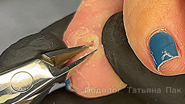 У мозоли нет шанса остаться | вижу цель иду до конца #подологтатьянапак смотреть онлайн