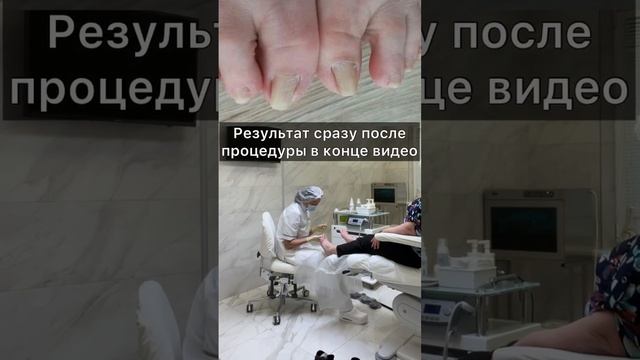 Консультация по ликвидации точки боли у пациента | #вросшийноготь #подологтатьянапак #подногтем смотреть онлайн
