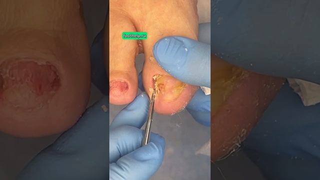 Грибок ногтей #подологмосква смотреть онлайн