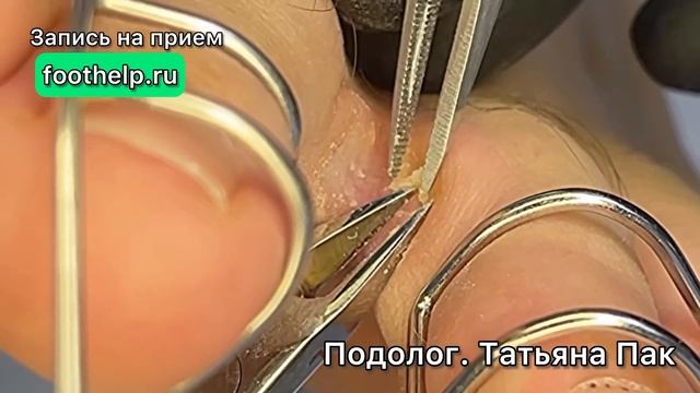 Корешковая мозоль справа и слева на пальцах в месте соприкосновения, трения и давления смотреть онлайн