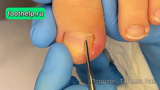 Динамика вросшего ногтя за 2 недели | почему другой специалист не смог помочь смотреть онлайн
