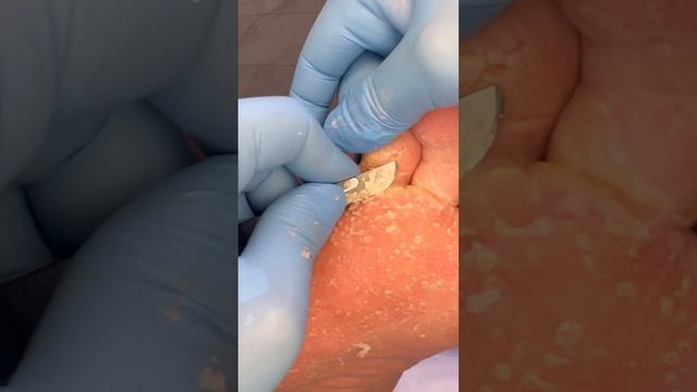 Постоянно влажные стопы. Кожа при гипергидрозе #подолог смотреть онлайн