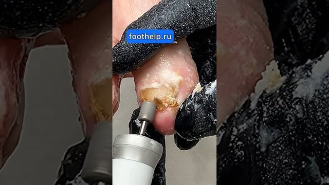 Коготь Грифона | дать второй шанс безнадежному ногтю | #подолог #ногти смотреть онлайн