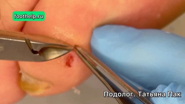 Почему образовывается мозоль на мизинце смотреть онлайн