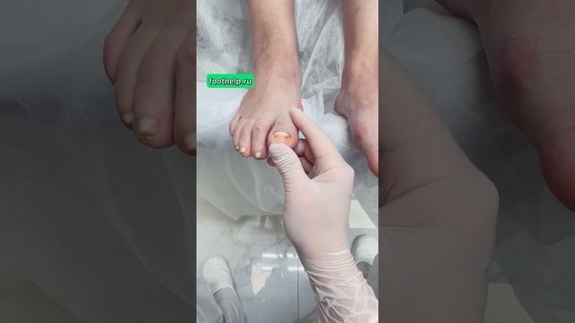 Восстановление безнадежных ногтей #ногти #подология #podologia #подологтатьянапак #вросшийноготь смотреть онлайн