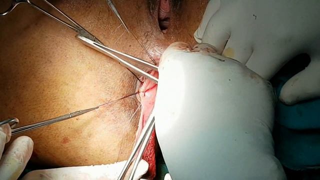 Rectal prolapse ; How I Do it ? смотреть онлайн