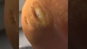 Стержневые мозоли