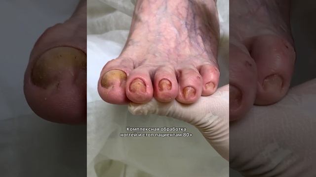 Грибковое поражение ногтей в пожилом возрасте | Медицинский педикюр #подологтатьянапак смотреть онлайн