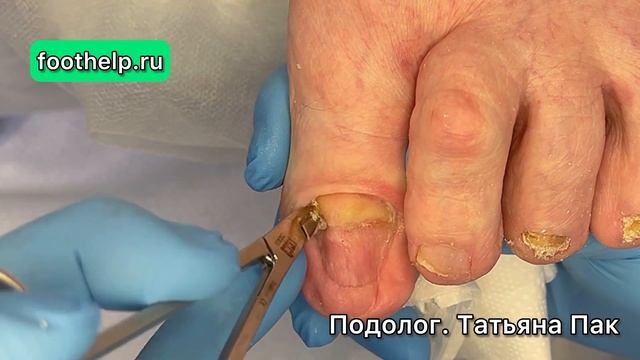 Вместо ногтя вырос коготь орла #подологтатьянапак смотреть онлайн