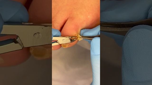 Снова выросла #мозоль смотреть онлайн