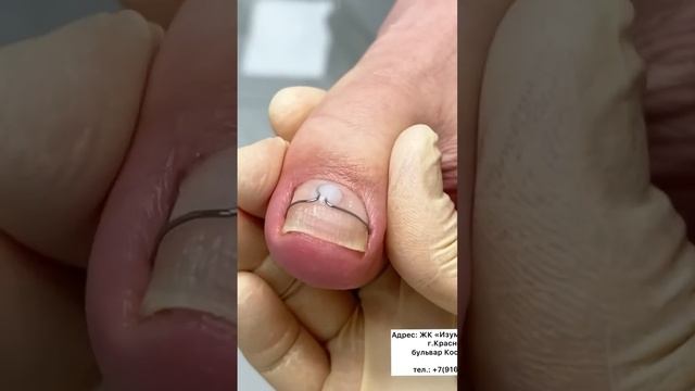 Скобы для скрученных ногтей. Больше видео на моем канале @podologmoscow #вросшиеногти смотреть онлайн