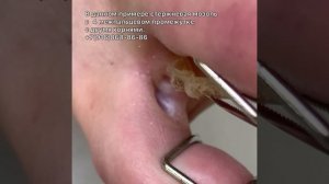 Двухкорневая мозоль между мизинцем и четвертым пальцем