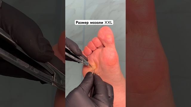 Глубоко посаженная мозоль | #подологтатьянапак смотреть онлайн