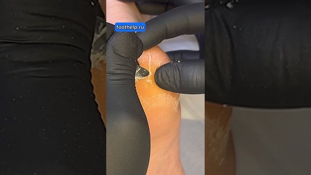 Нарезать кератоз на тонкие пластинки #трещинынапятках смотреть онлайн