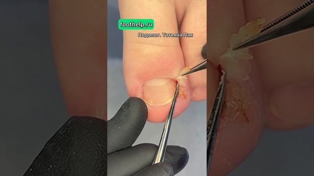 Удаление вросшего ногтя у #подологтатьянапак смотреть онлайн