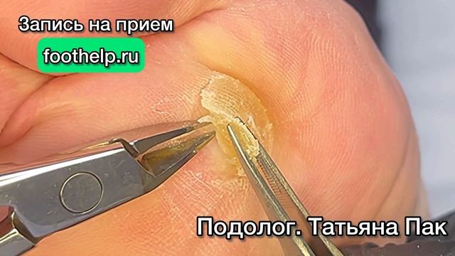 Место образования сухих мозолей. Как облегчить болезненное состояние смотреть онлайн