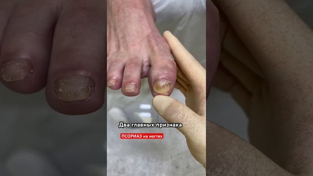 Как определить псориаз по первым признакам | аутоиммунное заболевание #подологмосква #псориаз смотреть онлайн